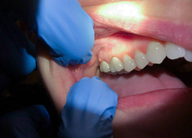 Best Emergency Denture Repair in Ocean View, DE